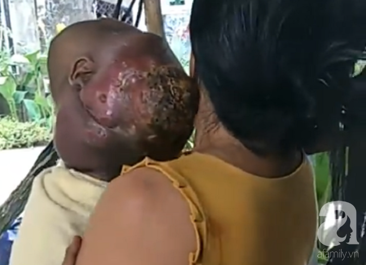 Bé trai 6 tuổi ở Tây Ninh mang khối u ác tính to khủng khiếp trên mặt vì cha dẫn đi đắp lá thuốc trôi nổi - Ảnh 3.