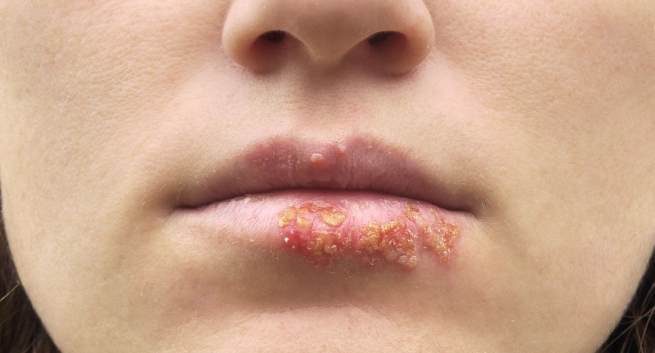 Nhận biết bệnh Herpes - mụn rộp sinh dục thông qua những triệu chứng cơ bản - Ảnh 4.