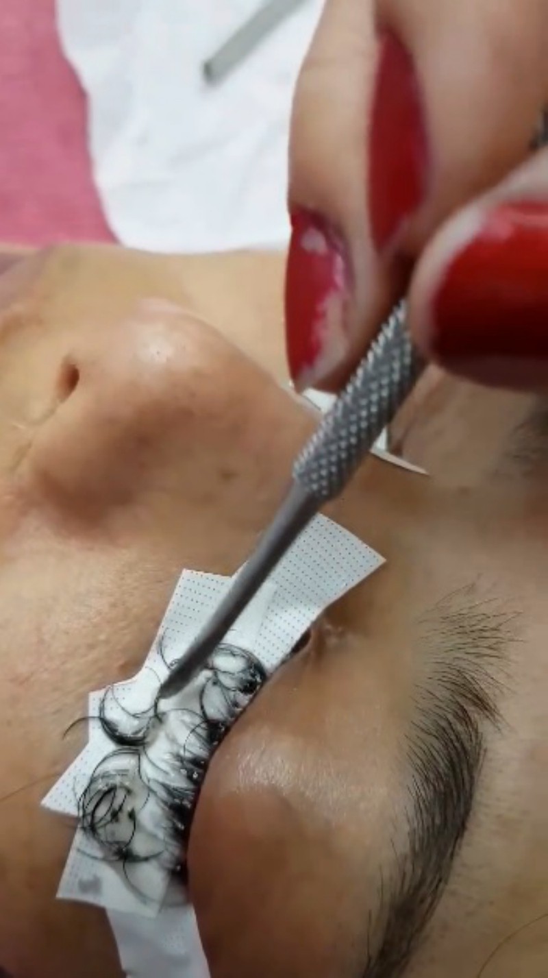 Cô gái đau đớn lĩnh hậu quả với đôi mắt sưng húp, rụng sạch lông mi vì nối mi bằng keo dán sắt - Ảnh 2.