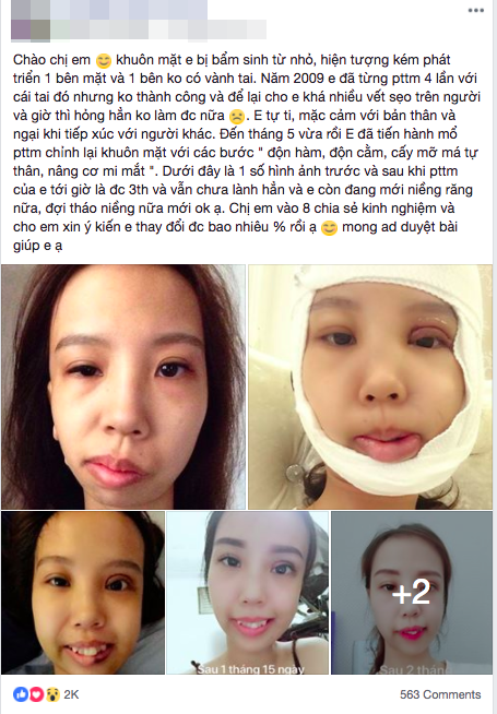 Bị bạn bè trêu chọc vì teo nửa bên mặt, cô gái Hà Nội lột xác sau phẫu thuật thẩm mỹ - Ảnh 1.
