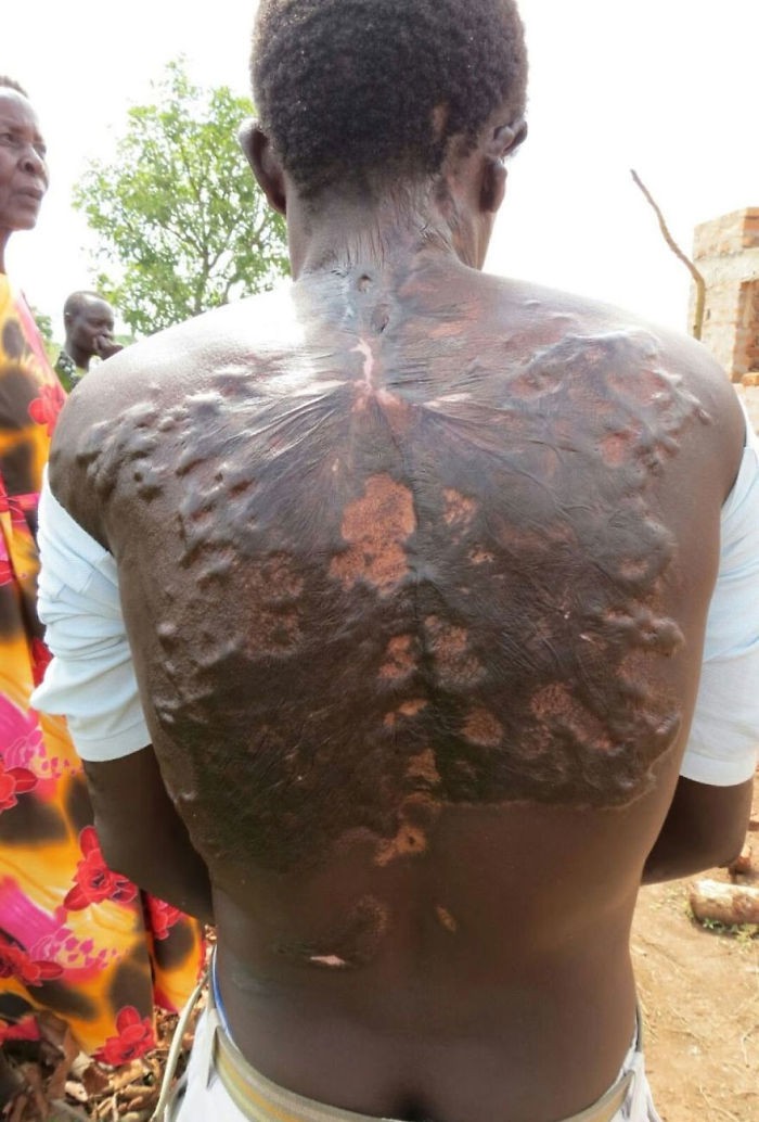 Những điều khủng khiếp diễn ra trong cơ thể khi bị sét đánh và bí ẩn “hoa sét” trên những người sống sót kỳ diệu - Ảnh 3.