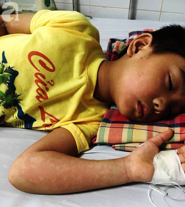 Hà Nội: Bé trai 7 tuổi đang khỏe mạnh bỗng hôn mê vì suy đa tạng, nhiễm trùng máu sau trận sốt cao - Ảnh 1.