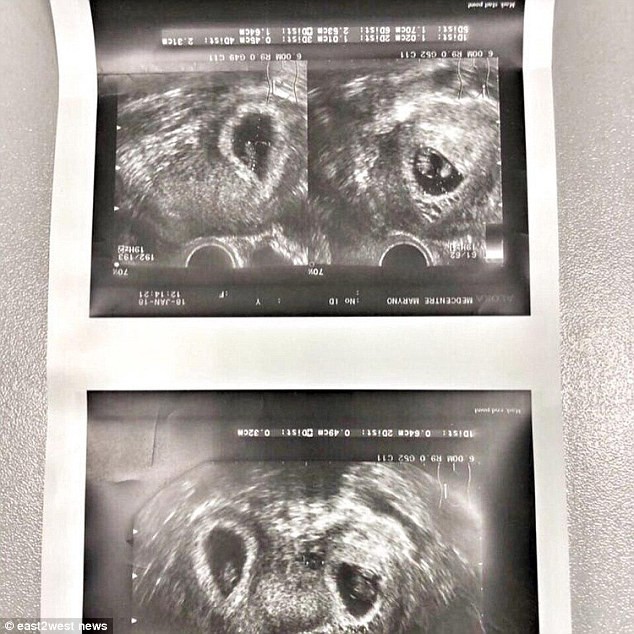 Sau khi mổ lấy thai sinh đôi, bác sĩ không tin vào mắt mình khi nhìn thấy tử cung của sản phụ - Ảnh 2.