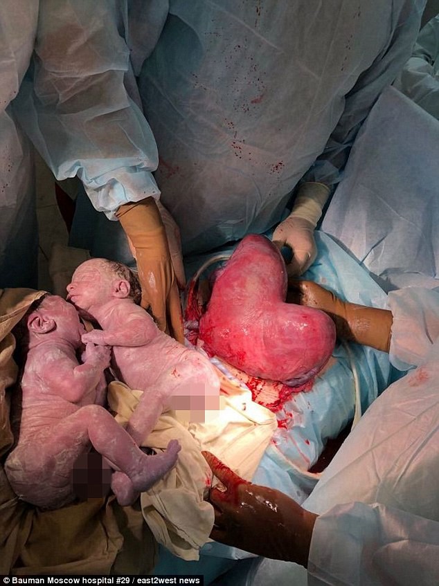 Sau khi mổ lấy thai sinh đôi, bác sĩ không tin vào mắt mình khi nhìn thấy tử cung của sản phụ - Ảnh 1.