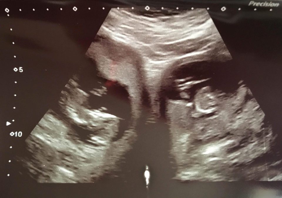 Sau khi mổ lấy thai sinh đôi, bác sĩ không tin vào mắt mình khi nhìn thấy tử cung của sản phụ - Ảnh 4.