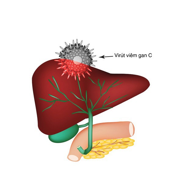 Viêm gan siêu vi C và các biến chứng thường gặp - Ảnh 1.
