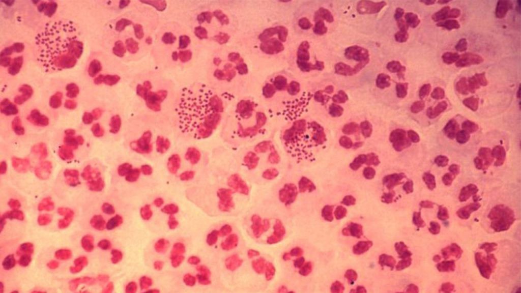 Những dấu hiệu nhận biết cơ bản của bệnh lậu - bệnh lây qua đường tình dục nguy hiểm không kém gì giang mai và chlamydia - Ảnh 2.