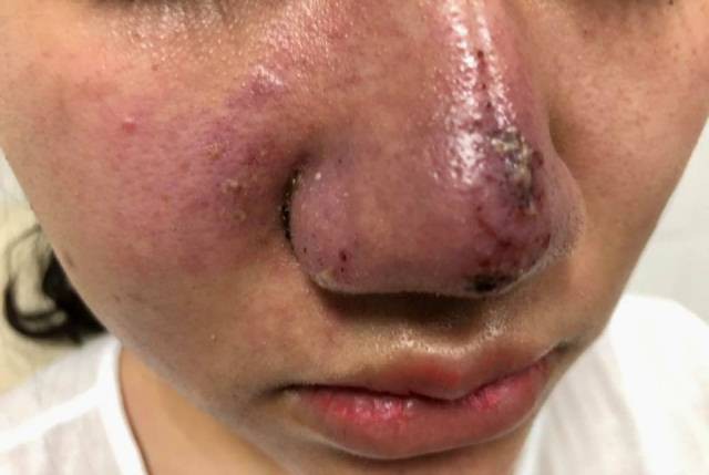 Hà Nội: Thêm một phụ nữ bị biến chứng méo mặt vì tiêm filler - Ảnh 2.