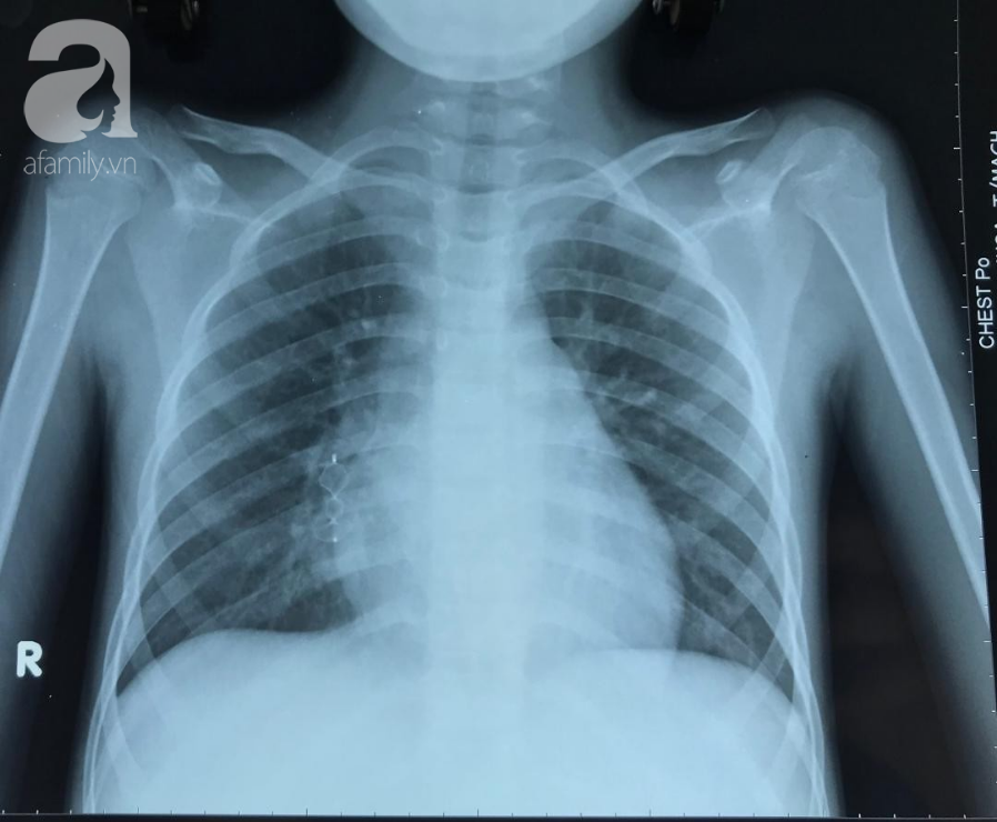 Tưởng là lao phổi nhưng khi chụp CT, bác sĩ phát hiện bé 11 tuổi suýt tử vong vì căn bệnh hiếm gặp - Ảnh 2.