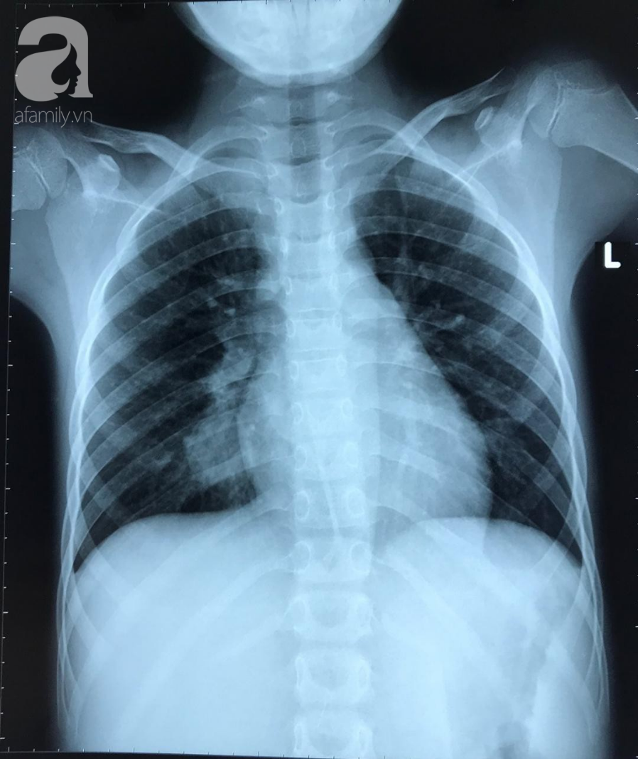 Tưởng là lao phổi nhưng khi chụp CT, bác sĩ phát hiện bé 11 tuổi suýt tử vong vì căn bệnh hiếm gặp - Ảnh 1.