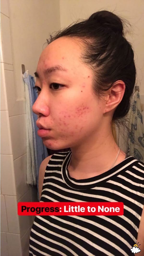 Thoa dầu dừa lên da trong 1 tuần để chữa sẹo mụn, cô nàng này đã nhận được kết quả đáng thất vọng - Ảnh 5.