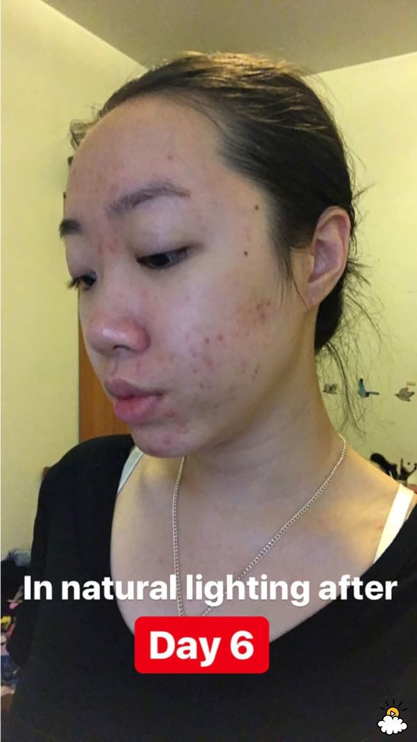 Thoa dầu dừa lên da trong 1 tuần để chữa sẹo mụn, cô nàng này đã nhận được kết quả đáng thất vọng - Ảnh 7.