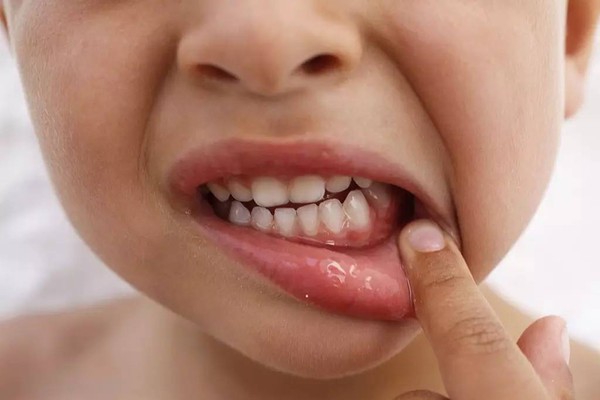 Bé gái 7 tuổi bị ung thư miệng, bác sĩ cảnh báo cha mẹ cần chú ý trong việc chăm sóc răng miệng cho trẻ - Ảnh 2.