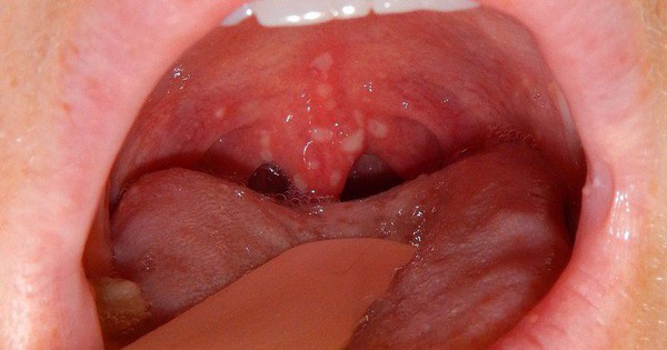 Nếu dấu hiệu chết người này không hết sau 2 - 3 tuần, hãy cẩn trọng với ung thư cổ họng - Ảnh 1. Nếu dấu hiệu chết người này không hết sau 2 - 3 tuần, hãy cẩn trọng với ung thư cổ họng - Ảnh 1.