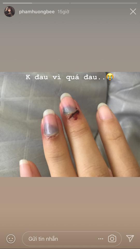 Phạm Hương bất ngờ đăng tải hình ảnh các ngón tay bị bầm dập khiến fan sốt xình xịch vì lo lắng - Ảnh 2.