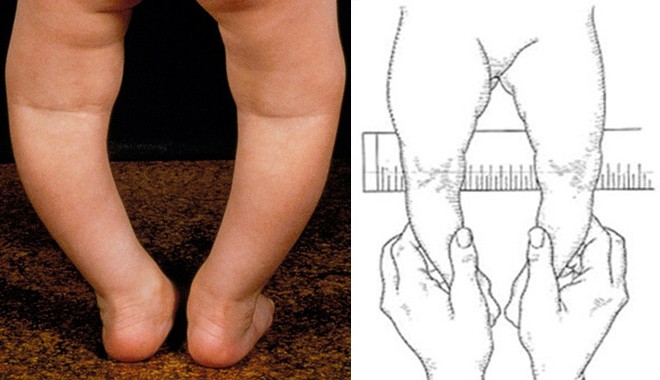 Варусная деформация стоп. Варусная деформация стопы косолапость. Варусная косолапость косолапость. Врожденная косолапость ноги. Эквиноварусная косолапость.