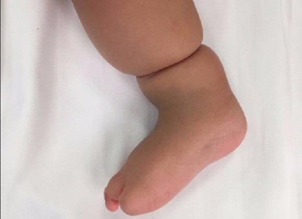 Đừng tưởng tay chân con có ngấn mà mừng, có thể bé đang mắc phải hội chứng nguy hiểm mà bố mẹ không biết - Ảnh 8.