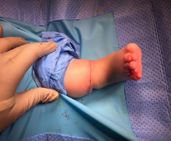 Đừng tưởng tay chân con có ngấn mà mừng, có thể bé đang mắc phải hội chứng nguy hiểm mà bố mẹ không biết - Ảnh 9.