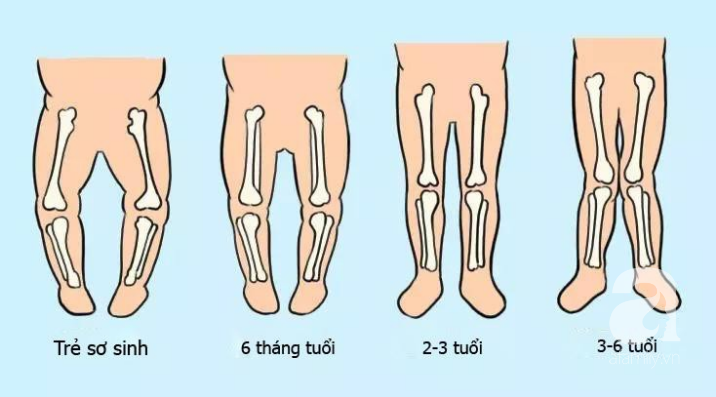 Chỉ mất vài giây để nhận biết chính xác trẻ có mắc tật chân vòng kiềng hay không và cách phòng tránh hiệu quả - Ảnh 2. Chỉ mất vài giây để nhận biết chính xác trẻ có mắc tật chân vòng kiềng hay không và cách phòng tránh hiệu quả - Ảnh 2.