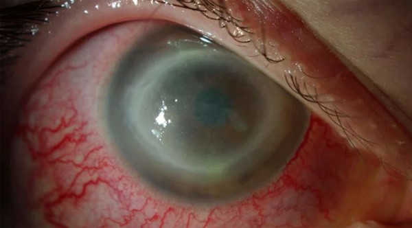 Bùng phát tình trạng nhiễm trùng mắt hiếm gặp bởi lý do này, bất kì ai cũng phải cảnh giác - Ảnh 1.