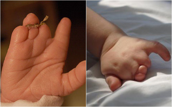 Mẹ lặng người khi sinh con ra không có bàn tay, bác sĩ mổ tìm thấy 1 bàn tay bé xíu còn nằm trong tử cung - Ảnh 5.