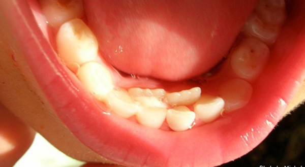 Nhiều biến chứng khôn lường từ việc bố mẹ tự nhổ răng sữa cho con tại nhà - Ảnh 3.