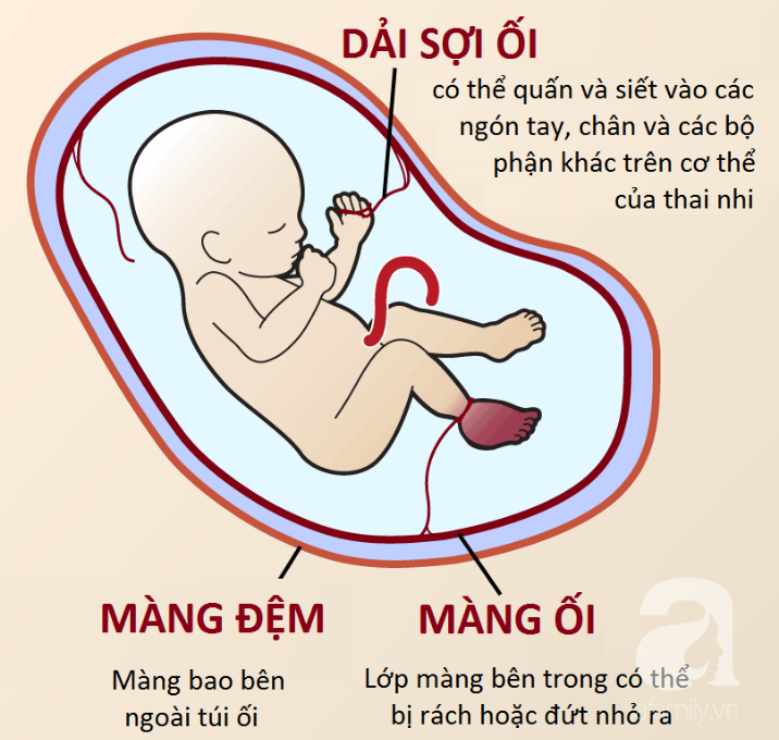 Tưởng tay chân con có ngấn là do bụ bẫm, nhưng có thể bé đang mắc một hội chứng dải sợi ối hiếm gặp