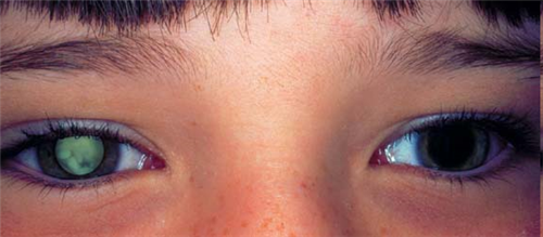 Bỗng dưng mắt con bị đốm sáng, lác mắt: Dấu hiệu cảnh báo trẻ bị bệnh ung thư nguy hiểm - Ảnh 2.