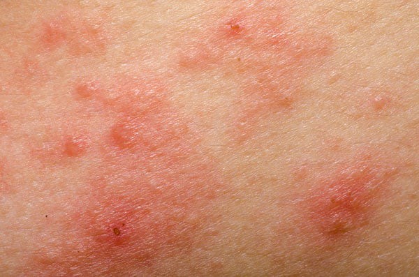 8 cách đơn giản phòng ngừa bệnh về da chàm eczema trong mùa đông - Ảnh 2.