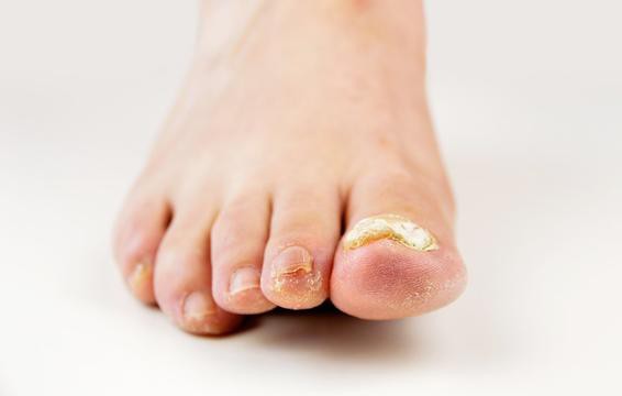 Những hiện tượng kinh khủng này có thể xuất hiện khiến sức khỏe bàn chân của bạn thêm tồi tệ - Ảnh 3.