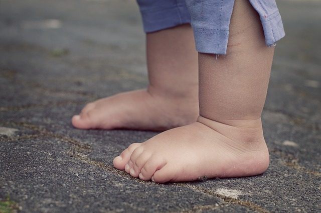 Dấu hiệu lạ ở bàn chân con cảnh báo hiện tượng mà 30% trẻ em Châu Á đang mắc phải - Ảnh 2.