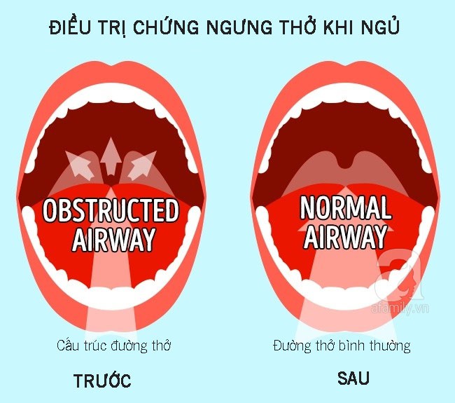 10 dấu hiệu cho thấy gan đang phải làm việc quá tải và chứa đầy độc tố, dễ phát triển thành gan nhiễm mỡ - Ảnh 9.