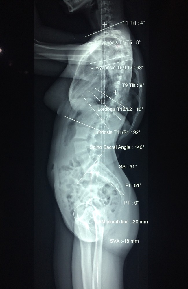 Thiếu nữ Kiên Giang mắc hội chứng hiểm, cột sống cong vẹo hình chữ S khi bắt đầu có kinh nguyệt - Ảnh 2.