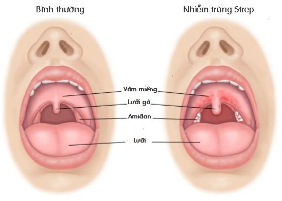 Bị bệnh có triệu chứng không khác gì bệnh cúm, bác sĩ đã chẩn đoán nhầm khiến cô bé 12 tuổi tử vong - Ảnh 3.