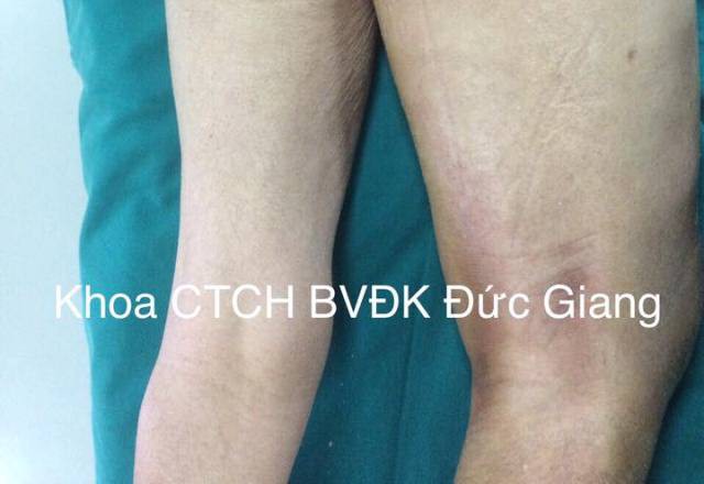  Hãi hùng bệnh nhân tự tiêm thuốc điều trị gout, hút ra 10 lít mủ - Ảnh 1.