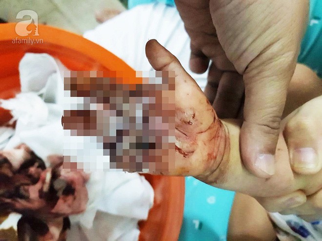 Bình Dương: Bé trai 2 tuổi bị sên xe máy quấn đứt lìa bàn tay - Ảnh 2.