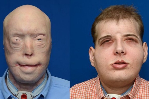 Các bác sĩ Pháp vừa làm nên lịch sử, khi cấy ghép khuôn mặt lần thứ hai cho cùng một người - Ảnh 1.