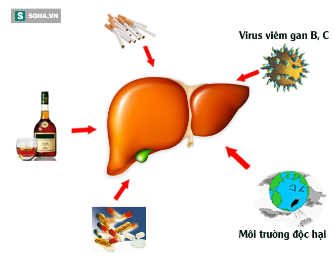 Những nhóm người dễ mắc ung thư gan hơn người khác: Hãy đề phòng! - Ảnh 2.