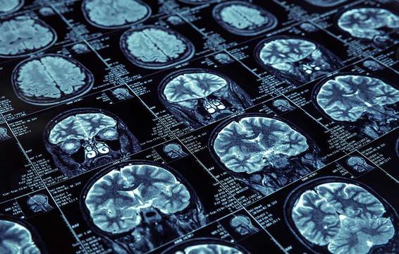 7 điều bác sĩ muốn bạn biết nhiều hơn về bệnh Alzheimer - Ảnh 7.