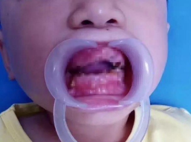 Bé trai 5 tuổi sau một đêm ngủ dậy rụng hết răng, nguyên nhân gây ra bởi thủ phạm quen mặt ai cũng biết nhưng đều xem nhẹ - Ảnh 1.