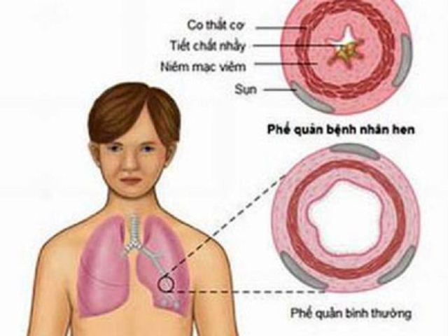 Nhiều người cấp cứu vì lên cơn hen trong rét đậm, bác sĩ chỉ cách phòng bệnh này - Ảnh 2.