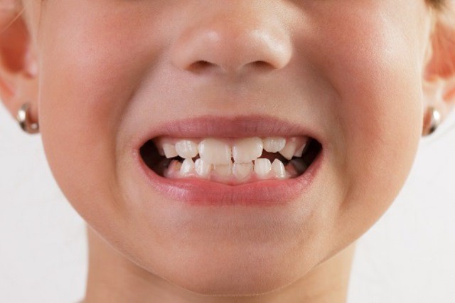 Lắng nghe ngay bác sĩ nha khoa chỉ điểm một số nguyên nhân gây ra hiện tượng nghiến răng ken két ở trẻ nhỏ - Ảnh 3.