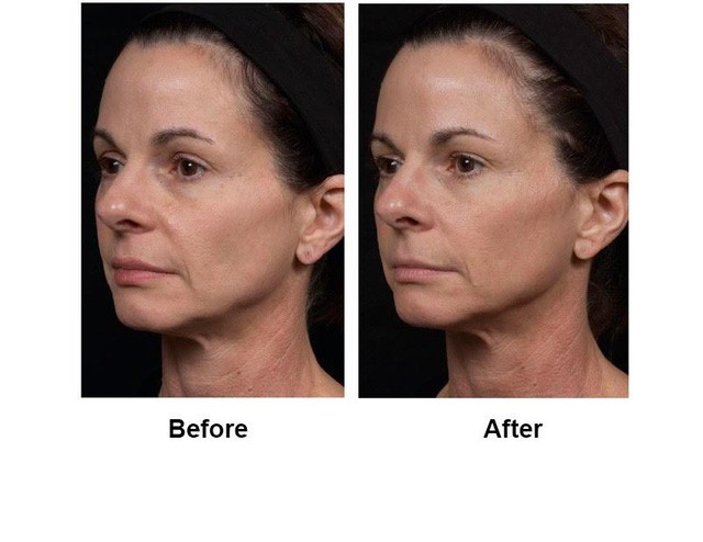 Trẻ hóa da, nâng cơ với công nghệ HIFU, Ultherapy và Thermage FLX của Vian Beauty - Ảnh 3.
