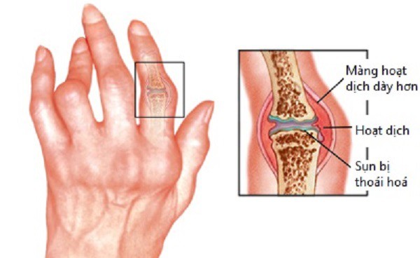 Bài thuốc trị sưng đau các khớp - Ảnh 1.