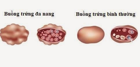 Phụ nữ mắc bệnh này không chỉ vô sinh mà còn có thế tiến triển thành ung thư - Ảnh 2.