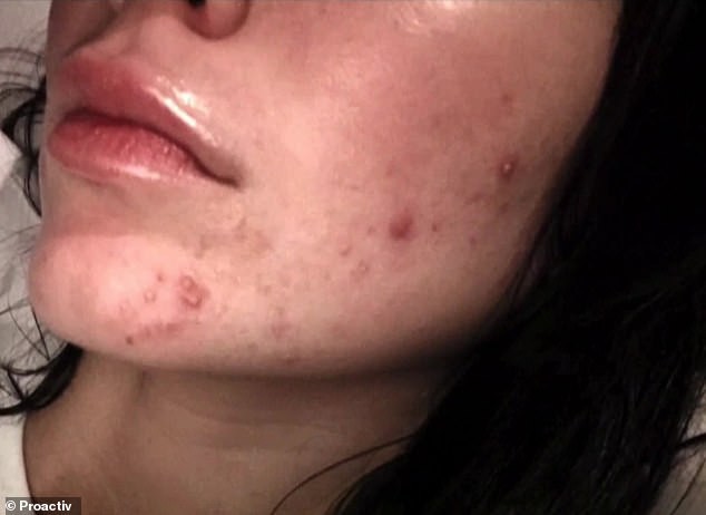Panorama of the acne cream advertising disaster that is causing Kendall Jenner to receive enough brickbats to build a villa - Photo 6.