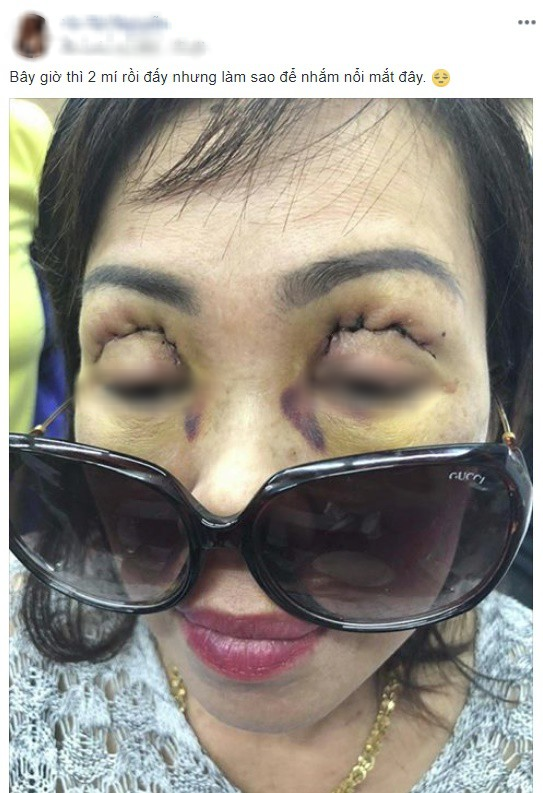 Vô vàn các biến chứng khi cắt mí mắt, nhấn mí thường gặp ở spa khiến chị em nhận trái đắng - Ảnh 4.