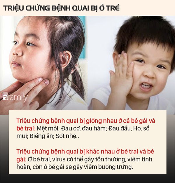 Bệnh quai bị có triệu chứng như thế nào?