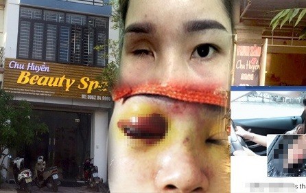 Tiệm spa nâng mũi khiến cô gái bị mù vĩnh viễn từng bị đình chỉ  - Ảnh 1.