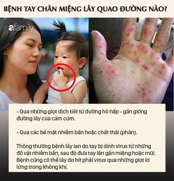 Cảnh báo bệnh tay chân miệng vào mùa: Bệnh tay chân miệng lây qua đường nào? - Ảnh 3.